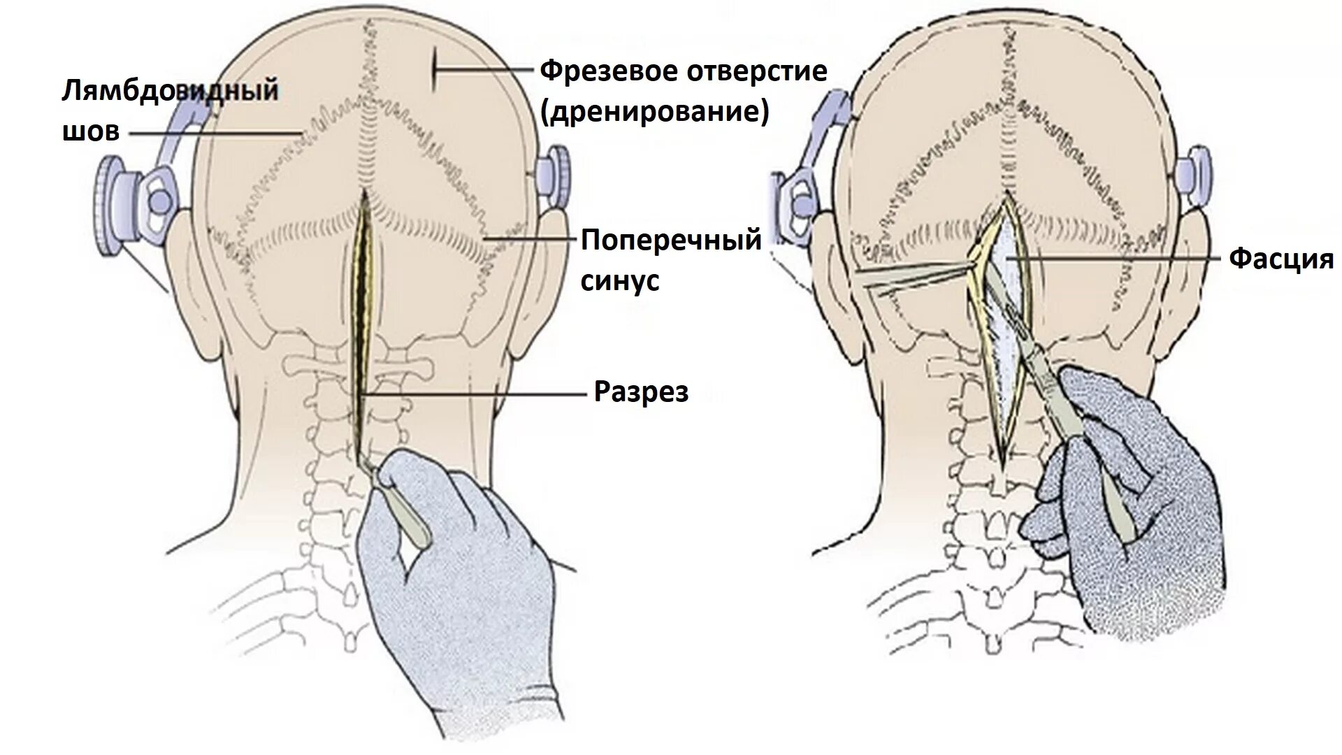 Субокципитальная Трепанация. Краниотомия задней черепной ямки. Операция на задней черепной ямки. Трепанация задней черепной ямки.