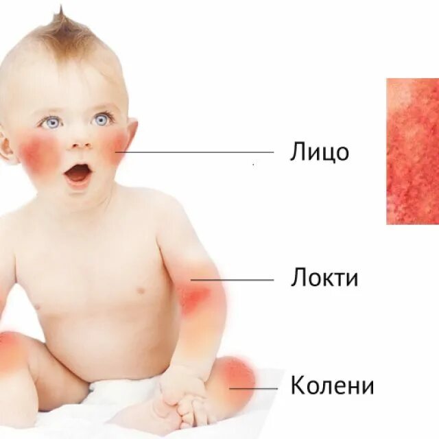 Атопич. Аллергический атопический дерматит у ребенка 3 года. Атопический дерматит у детей грудничков. Аллергические диатезы у детей.