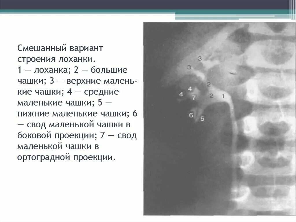 Структура лоханки. Типы строения лоханки почки. Варианты строения почечной лоханки. Смешанный Тип строения лоханки. Типы лоханок почек.