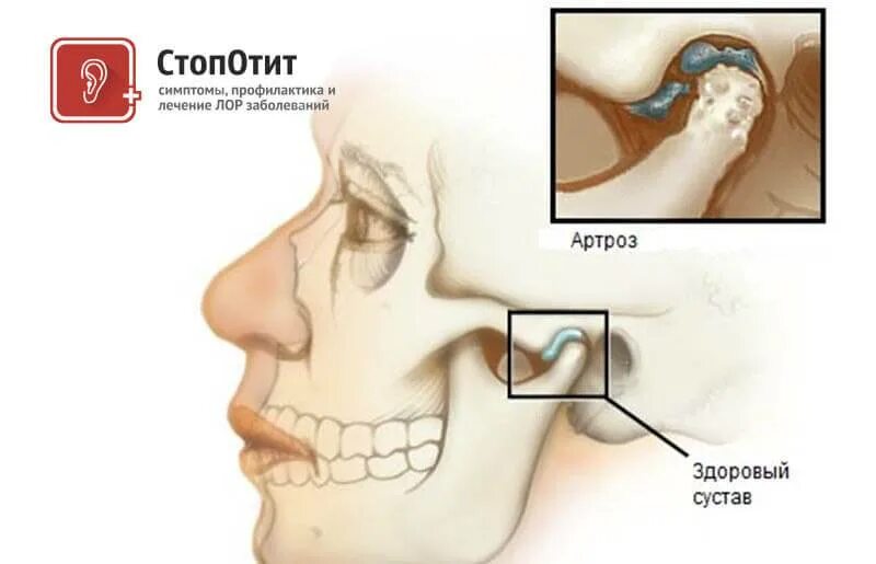От чего может болеть челюсть. Дисплазия челюстного сустава. Артроз височно челюстного сустава. Артрит челюстного сустава мазь.