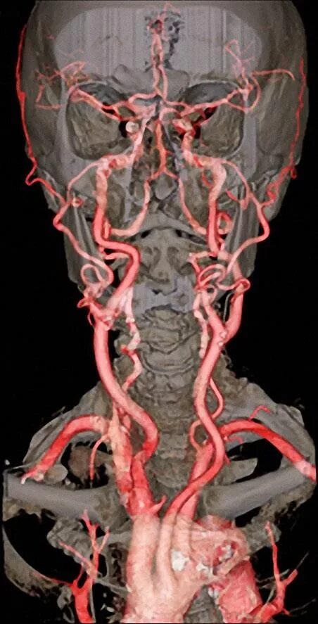 Тромбозы сосудов головного. Позвоночная артерия анатомия атлас. Ангиография позвоночной артерии. Кт ангиография сонных артерий. Брахиоцефальные артерии анатомия кт.