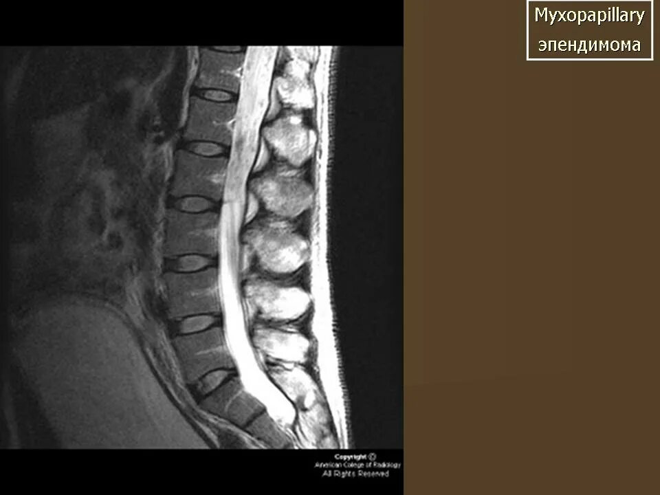 Эпендимома спинного. Эпендимома спинного мозга. Эпендимома мрт позвоночника. Эпендимома терминальной нити.