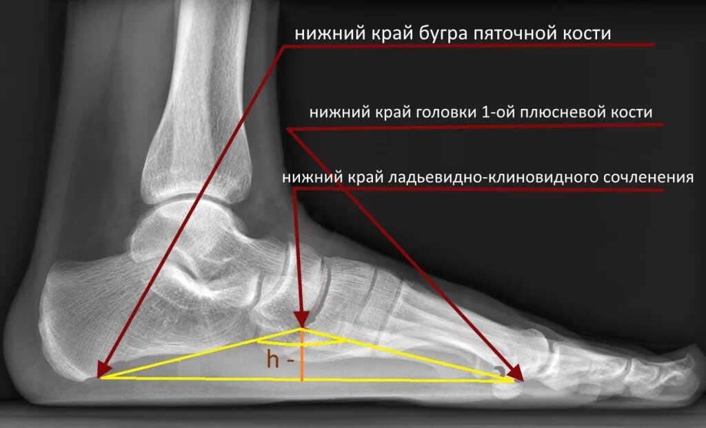 Изменения голеностопного сустава. Продольное плоскостопие 3 степени угол свода. Плоскостопие 3 степени угол свода. Таранно-пяточно-ладьевидный сустав рентген. Плоскостопие 3 степени высота свода.