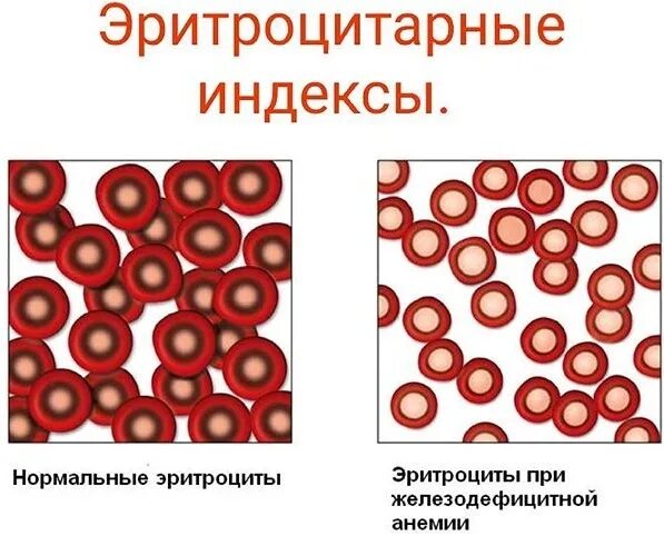 Тест эритроциты. Железодефицитная анемия гистология. эритроциты при анемии у детей. железодефицитная анемия рисунок. индексы эритроцитов при анемии.