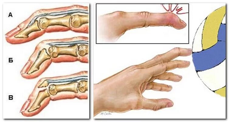 Отрыв сухожилия разгибателя пальца. Разрыв разгибателя пальца фаланги. Перелом безымянного пальца 1 фаланги. Перелом проксимальной фаланги 1 пальца. Нападение большого пальца
