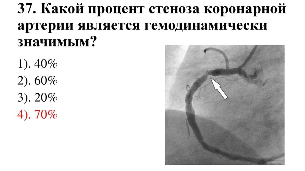 Процент стеноза сосудов