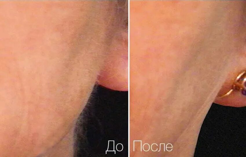 Удалить пушковый волос. Удалить пушковый волос. Пушковый волос на лице у женщин. Длинный пушковый волос на лице. Удалить пушковый волос.