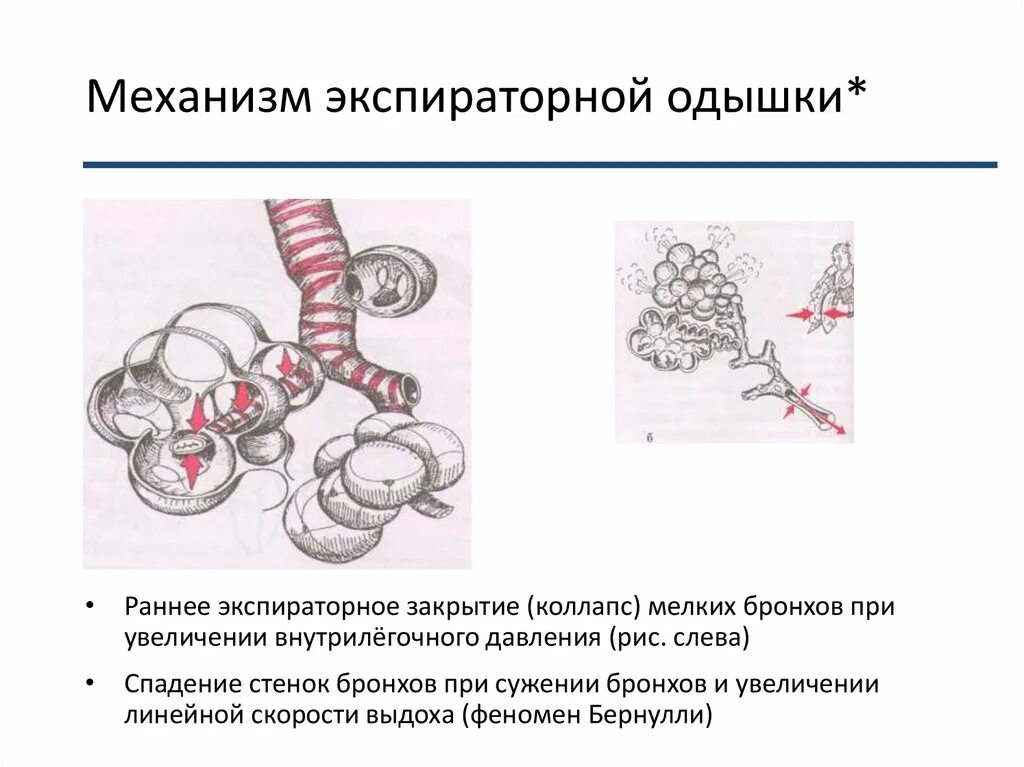 Спадение бронха. Спадение бронха