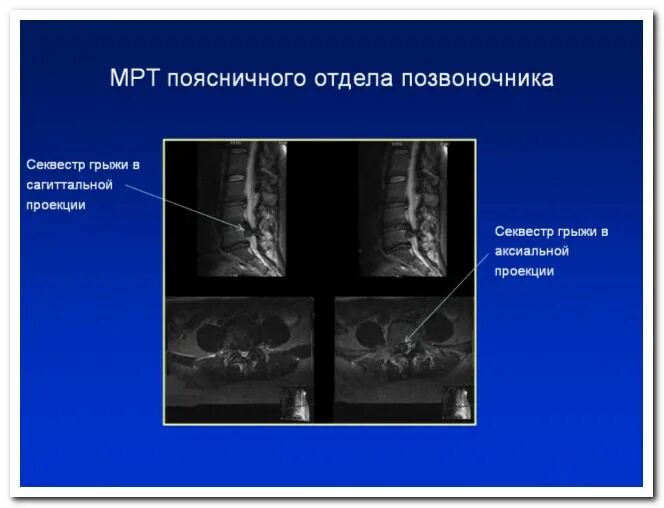 Грыжа поясничного отдела лечение у мужчин симптомы. Грыжа диска позвоночника поясничного отдела. Грыжа поясничного отдела мрт. Секвестрированная грыжа позвоночника поясничного отдела мрт. Грыжа пояснично-крестцового отдела секвестрированная.