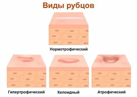 Ткань рубца