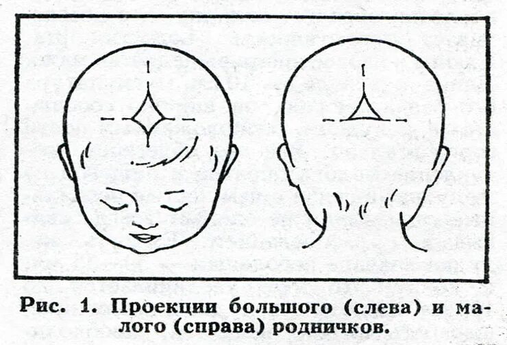 Измерение родничка. Большой и малый Родничок у новорожденного. Форма малого родничка у новорожденного. Родничок и темечко у новорожденных. Норма темечки у младенцев.