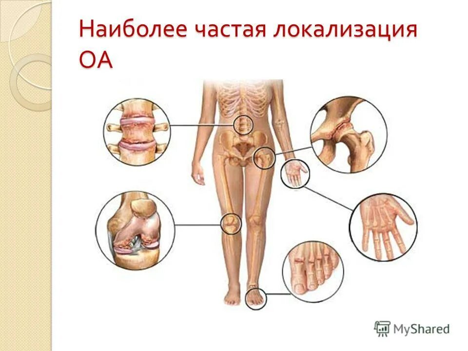 степени поражения суставов. ревматоидный артрит анкилозы. разрушение хряща и костей коленного сустава. остеоартроз презентация. типы суставов артроз.