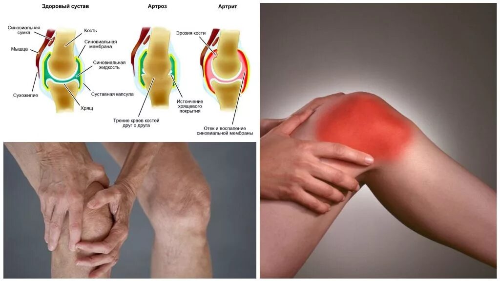 Какая боль при артрите. Ревматоидный артрит и артроз. Ревматоидный артрит колена симптомы. Остеоартроз и артрит разница. Симптомы артрит ревматоидный остеоартроз.