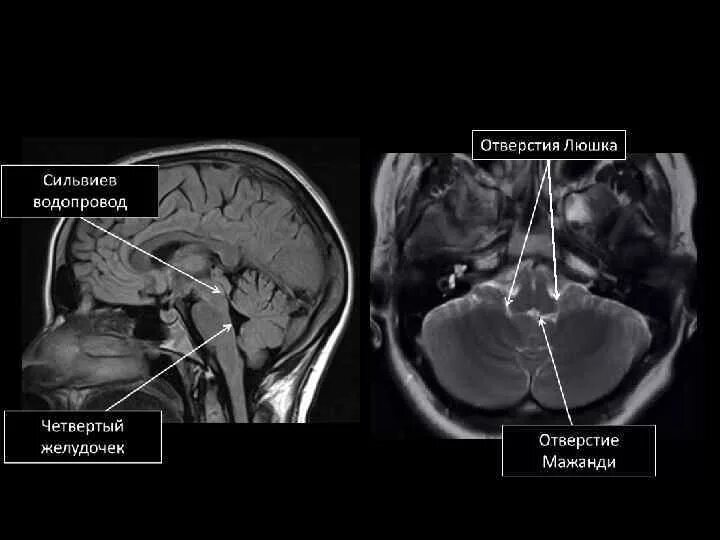 Цистерны мозга расширены. СИЛЬВИЕВ водопровод мрт анатомия. Отверстие Монро мрт анатомия. Анатомия мозжечка мрт. Боковые желудочки анатомия кт.