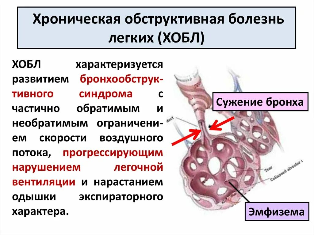 Эмфизема хронического бронхита. Механизм развития подкожной эмфиземы. Хронический бронхит механизм развития. Обструктивный бронхит. Острый обструктивный бронхит.