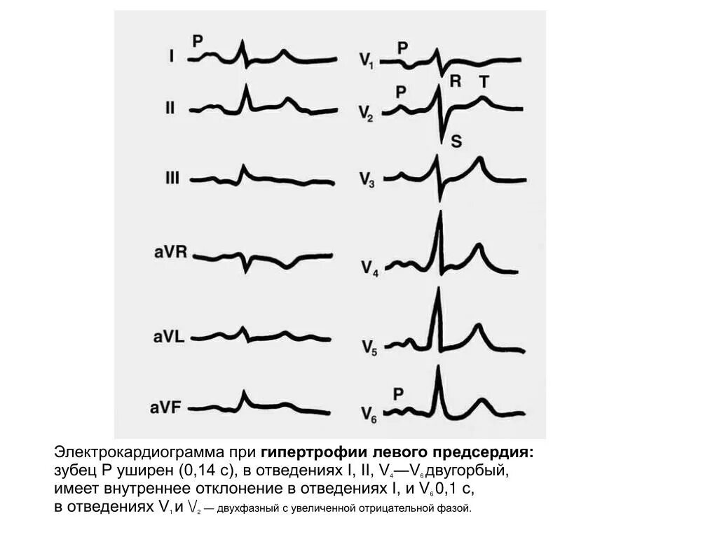 Нарастание зубца r. Зубец s на ЭКГ В разных отведениях. Двухфазный зубец r в 3 отведении. Двухфазный v1 v2 ЭКГ это. В ЭКГ V 1 двухфазный зубец.