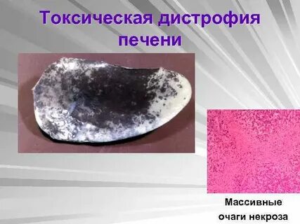 Острая токсическая дистрофия печени