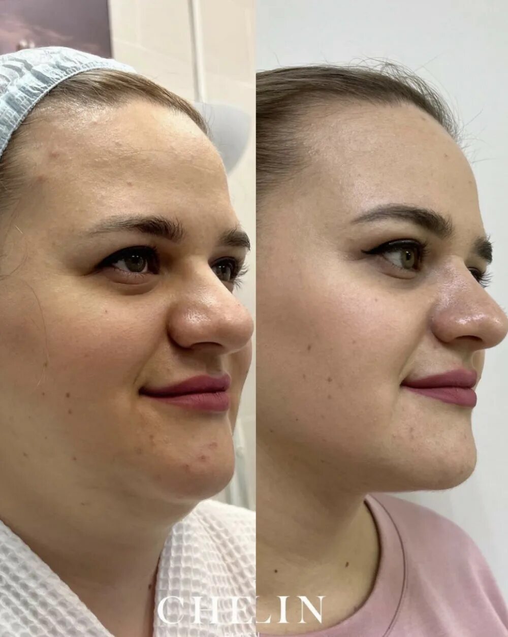 Pin on Cosmetic Surgery Blogs