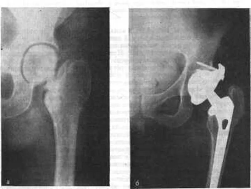 Перелом шейки бедра в пожилом возрасте. Ложный сустав шейки бедренной кости. Внесуставные переломы шейки бедра. Перелом эндопротеза тазобедренного сустава. Сросшийся перелом шейки бедренной кости.