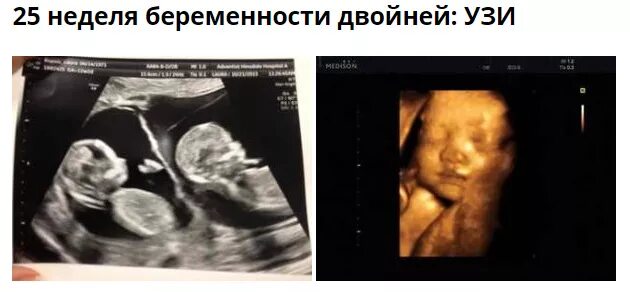 УЗИ 24 недели беременности двойней. УЗИ плода на 23 неделе беременности. Снимок УЗИ на 23 неделе беременности. Фото УЗИ двойни на 20 неделе беременности. Двойня 25 недель