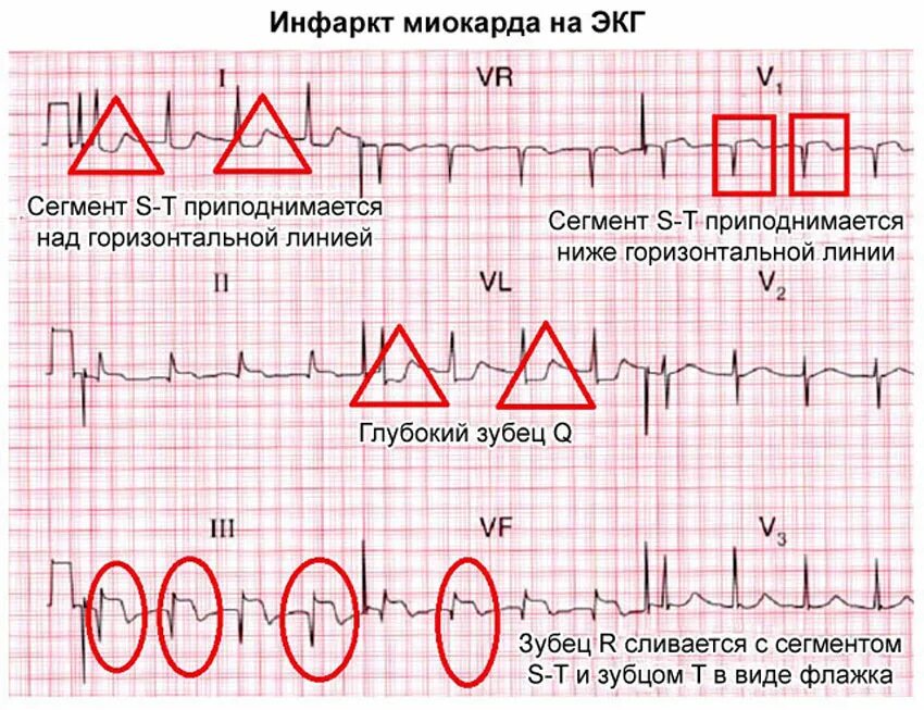 Мв на экг. Изменения на ЭКГ при инфаркте миокарда. Инфаркт миокарда на ЭКГ расшифровка. Инфаркт миокарда зубцы на ЭКГ. ЭКГ при острой стадии инфаркта миокарда.