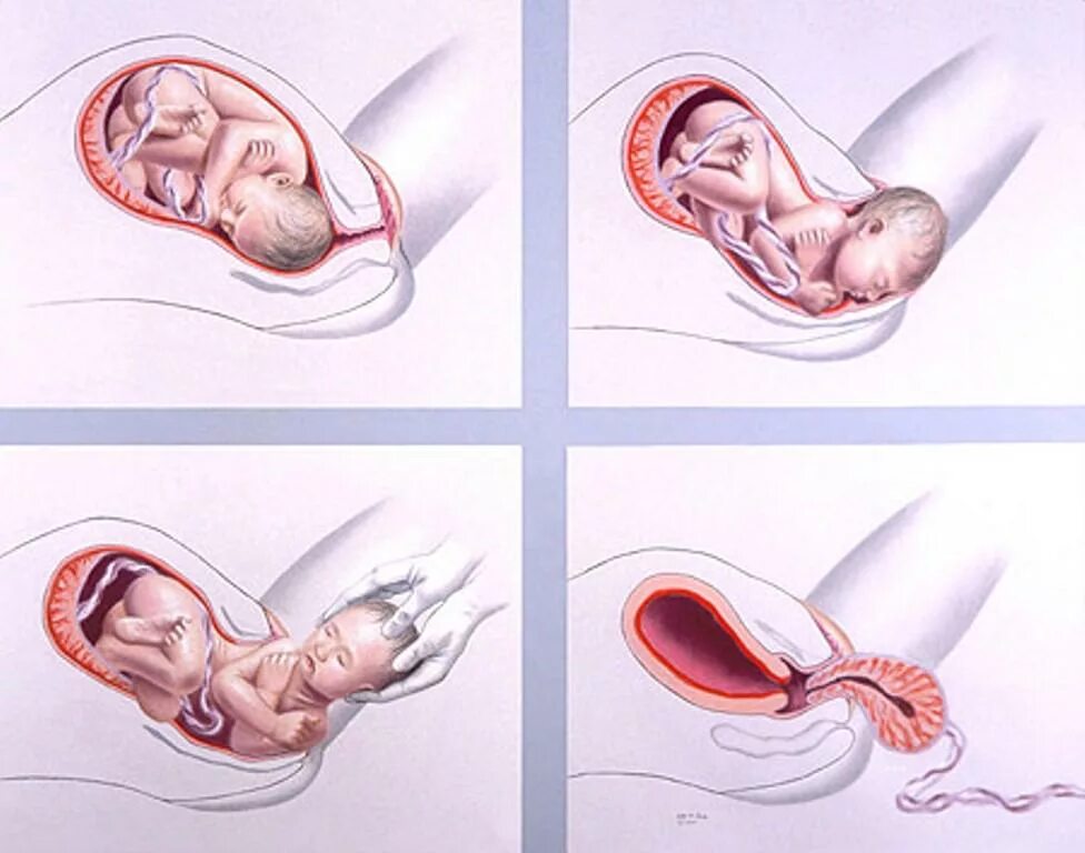Схватки 4 беременность. Процесрожденияребенка.