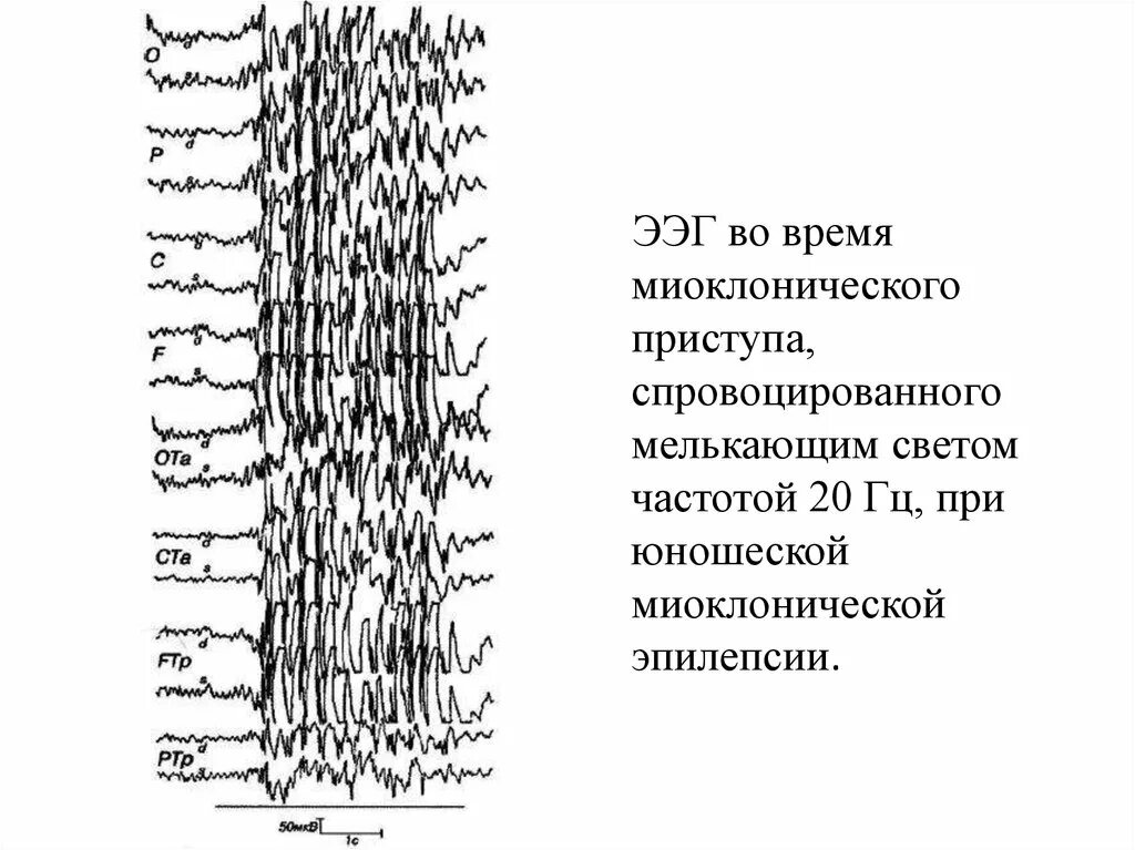 Эпи ээг. Эпиактивность на ЭЭГ. Миоклоническая эпилепсия ЭЭГ. ЭЭГ при приступе эпилепсии. Юношеская миоклоническая эпилепсия ЭЭГ.