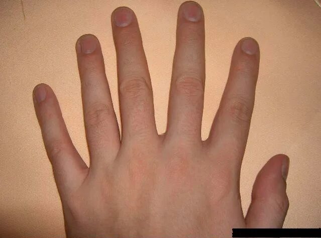 На 1 руке 6 пальцев. Люди с шестью пальцами на руке.