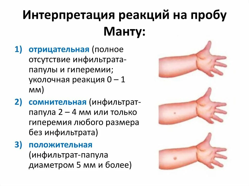 Оценка положительной реакции пробы манту. Диаскинтест диагностика туберкулеза. Оценка результатов туберкулинодиагностики диаскинтест. Реакции на туберкулин интерпретация. Реакция манту как часто