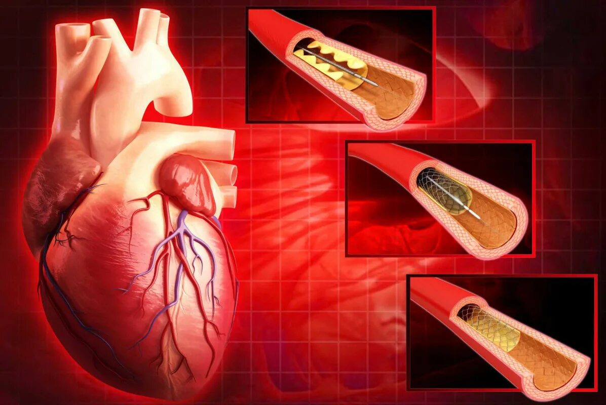 Стенты для сосудов. Аортокоронарное стентирование сосудов сердца. Острая ишемия миокарда. Инфаркт и стентирование сосудов сердца. Ишемическая болезнь сердца стенокардия инфаркт миокарда.