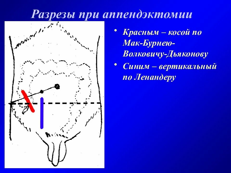 Точки аппендицита. Разрез Мак Бурнея Волковича Дьяконова. Доступы при аппендэктомии по Волковичу Дьяконову. Аппендэктомия разрез Волковича-Дьяконова. Разрез Волковича-Дьяконова при аппендиците.