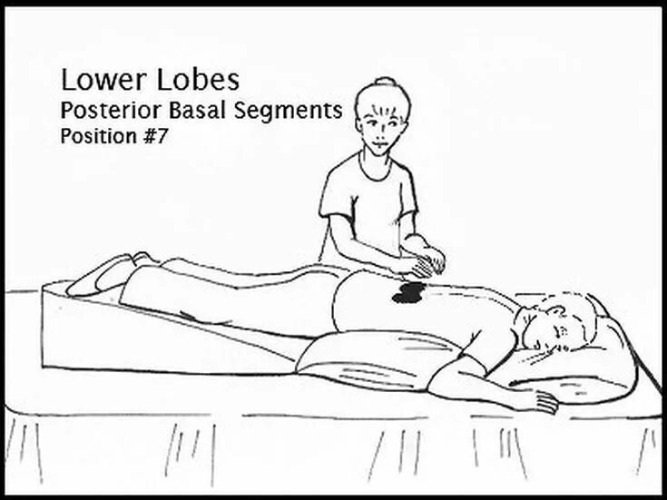 Постуральный дренаж. Постуральный дренаж алгоритм. Постуральный массаж при пневмонии. Постуральный массаж