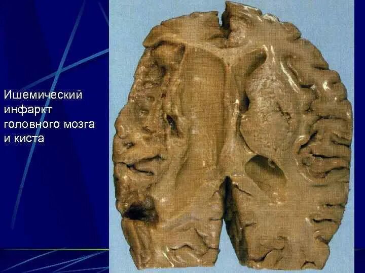 Размягчение головного мозга. Ишемический инфаркт головного мозга макропрепарат. Инфаркт головного мозга Патан. Инфаркт это колликвационный некроз. Колликвационный некроз макропрепарат.