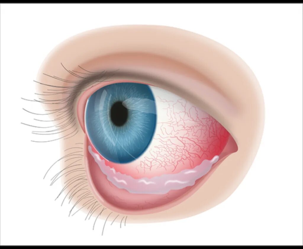 Конъюнктивит мешок конъюнктивальный. Хламидии конъюнктивит. Слизистая оболочка век