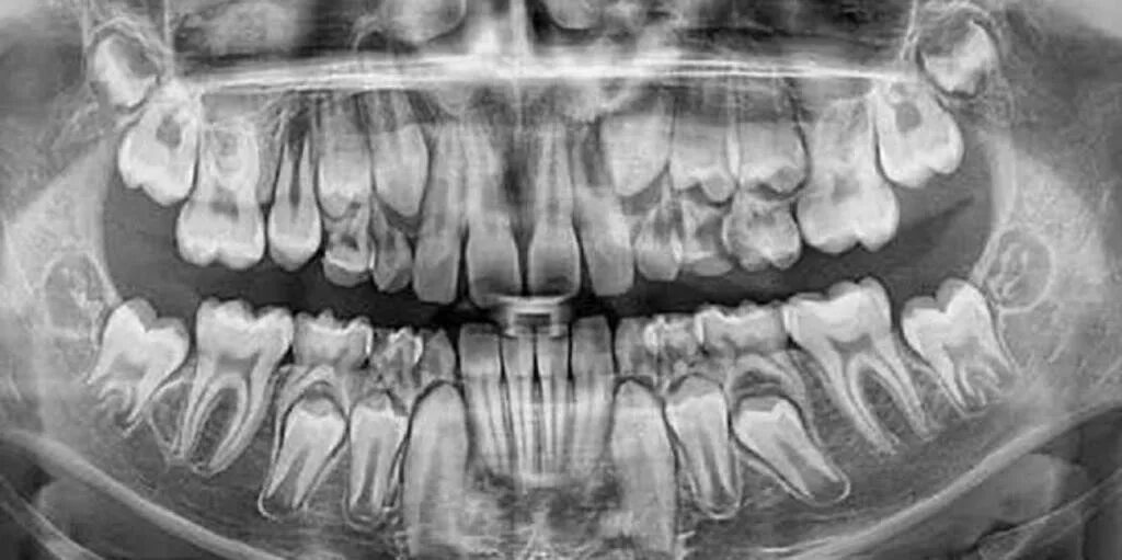 3 5 8 зуб. Сменный прикус рентген. Ортопантомограмма сменного прикуса.