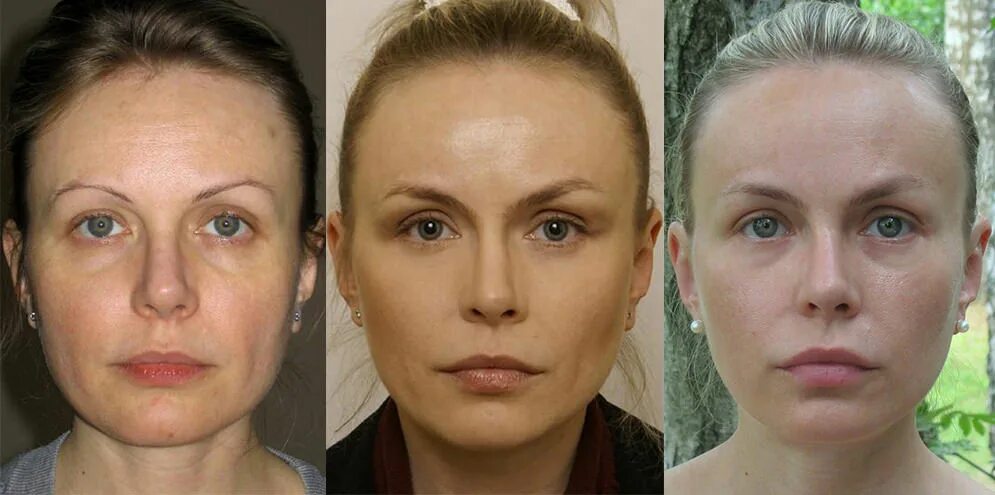 Малярные мешки до и после операции
