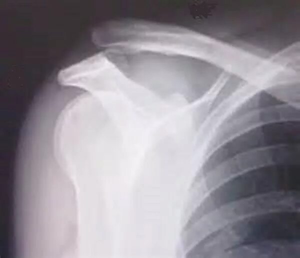 Вывих акромиального конца ключицы рентген. Вывих акс плечевого сустава. Разрыв акромиально-ключичного сочленения рентген. Перелом акромиального конца ключицы. Акромиальный отросток ключицы перелом.