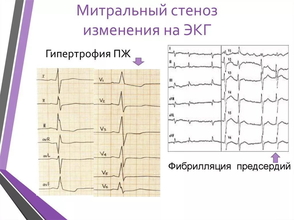 Митральный стеноз признаки. Стеноз митрального клапана ЭКГ. ЭКГ при стенозе митрального клапана. ЭКГ признаки митрального стеноза. Митральный стеноз ЭКГ.