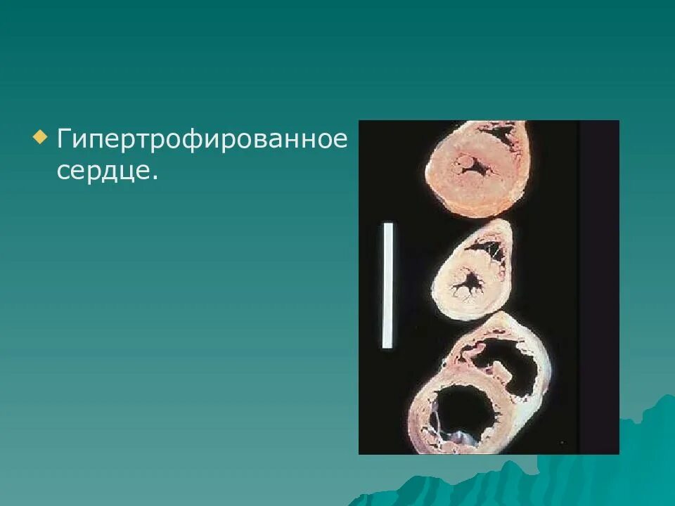 Гипертрофированное представление о роли. Гипертрофированное сердце. «гипертрофированное» сердце (в подростковом возрасте):. гипертрофированное понимание. гипертрофированный образ.