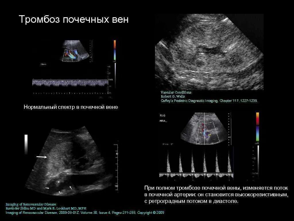 Тромбоз почечных вен