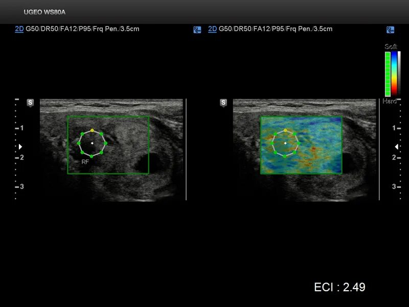 УЗИ эластография аппараты. УЗИ щитовидной эластография. Эластография щитовидной железы протокол. Эластография щитовидной железы Изранов.