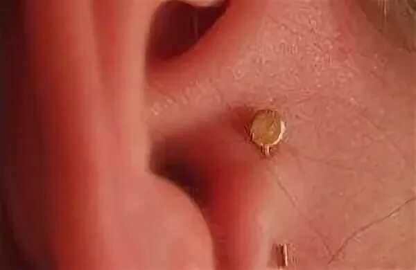 Серьга мухиной для похудения