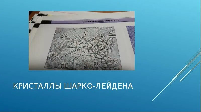 Кристаллы Шарко Лейдена. Кристаллы Шарко-Лейдена в мокроте. Кристаллические ФРАГМЕНТЫ Шарко-Лейдена. Кристаллы Шарко-Лейдена в Кале. Шарко кале