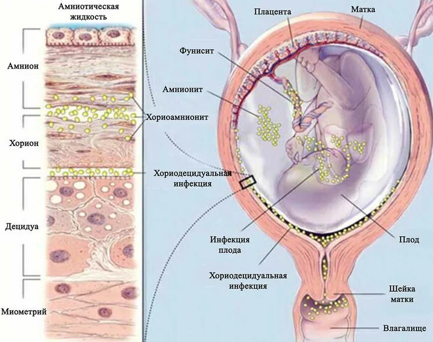 Заражение плода. Пути инфицирования плода. Заражение плода. Трансплацентарный путь передачи инфекции это. Критерии внутриутробной инфекции.