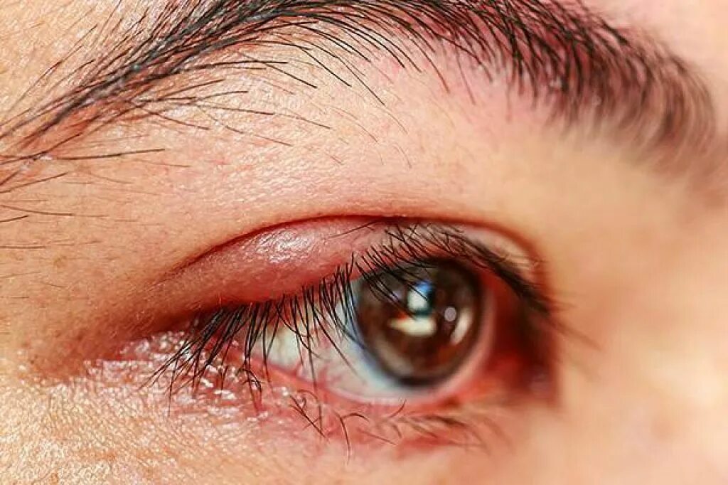 болит глаз лечение