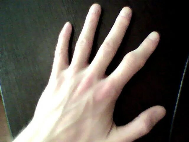 Выросли пальцы на руке. Перелелом указательного пальца. Перелом указательного пальца руки.