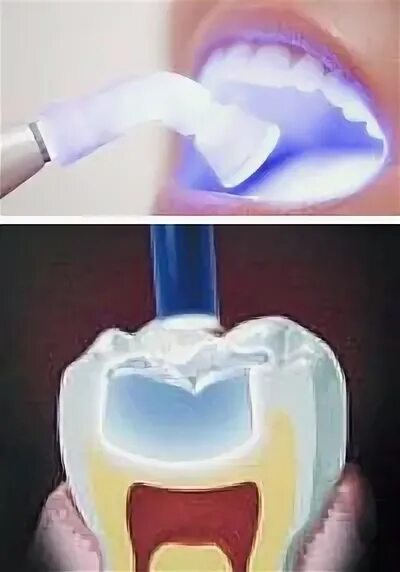 Светоотверждаемые (фотополимерные) пломбы. Пломба световой полимеризации. Светоотверждаемые (фотополимерные) пломбы. Световая фотополимерная пломба. Полимеризация пломбы.