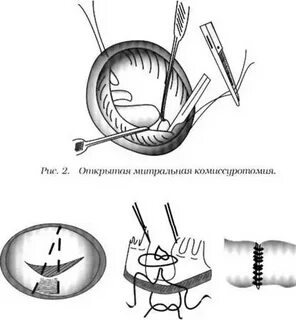 Комиссуротомия