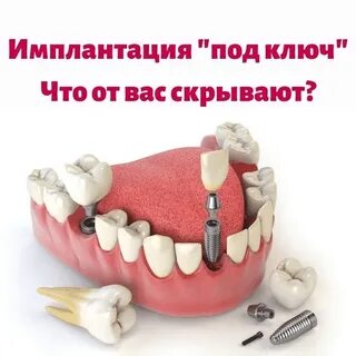 Имплантация под ключ в москве недорого