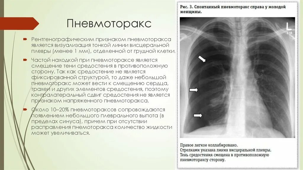Признаки воздуха в легких. Пневмоторакс рентген признаки. Пневмоторакс рентген описание. Рентгенография грудной клетки пневмоторакс. Правосторонний пневмоторакс рентген.